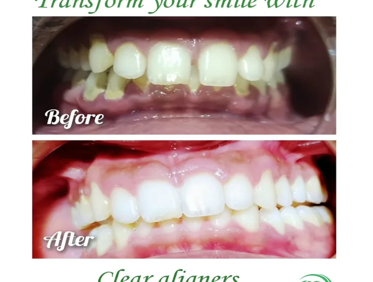 Clear aligner treatment before and after at Vallamattam Dental Clinic