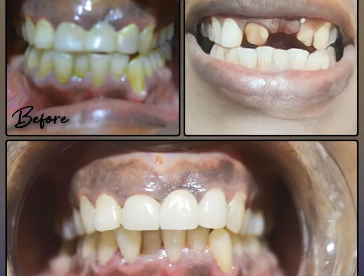 Restorative treatment result documented at Vallamattam Dental Clinic