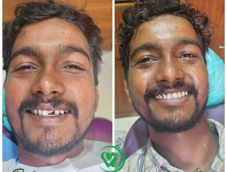 Smile makeover before and after at Vallamattam Dental Clinic