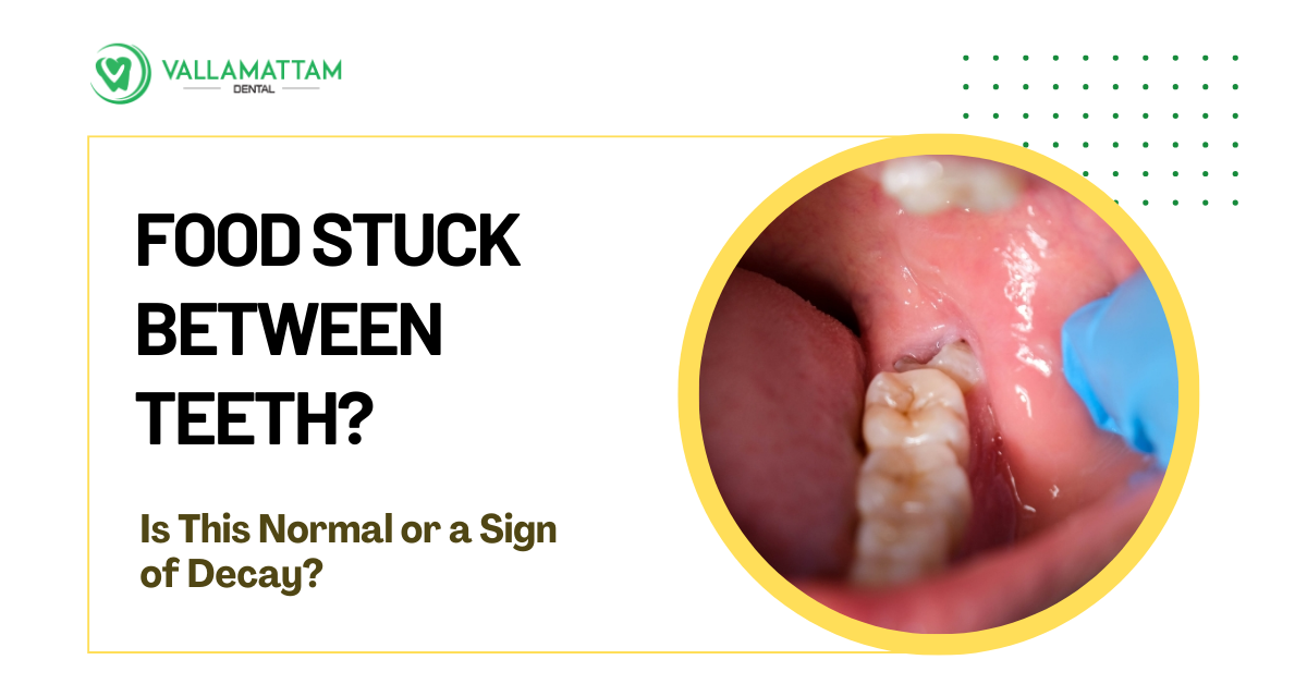 Blog image that features a close up of patient's teeth with food lodged between them found during dentist examination