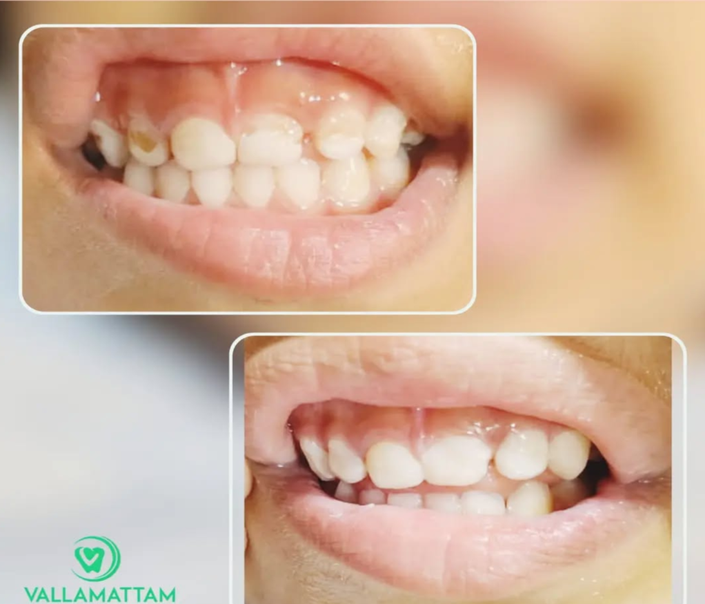 Before & After Picture of Tracey 6 Year Old Patient after Plaque Removal at Vallamattam Dental Clinic Kakkanad