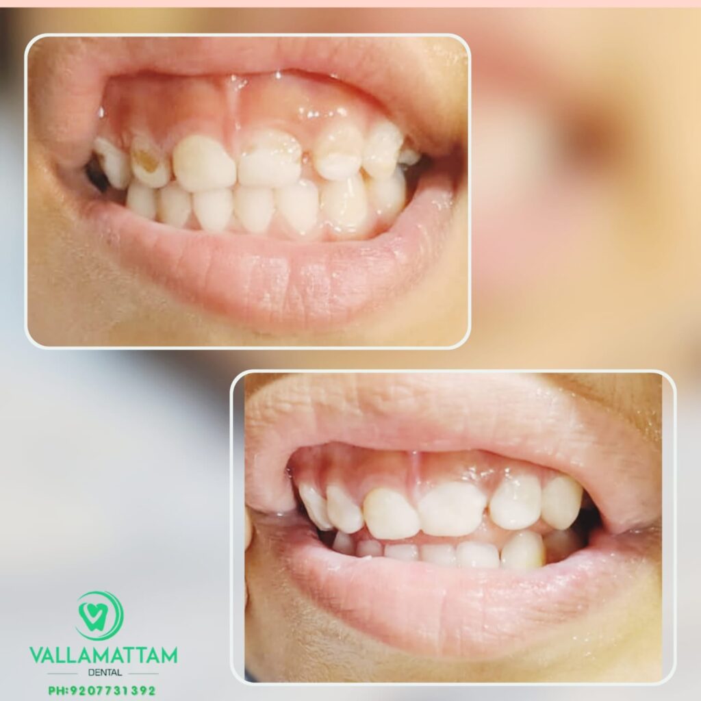 Before & After Picture of Tracey 7 Year Old Patient after Plaque Removal at Vallamattam Dental Clinic Kakkanad