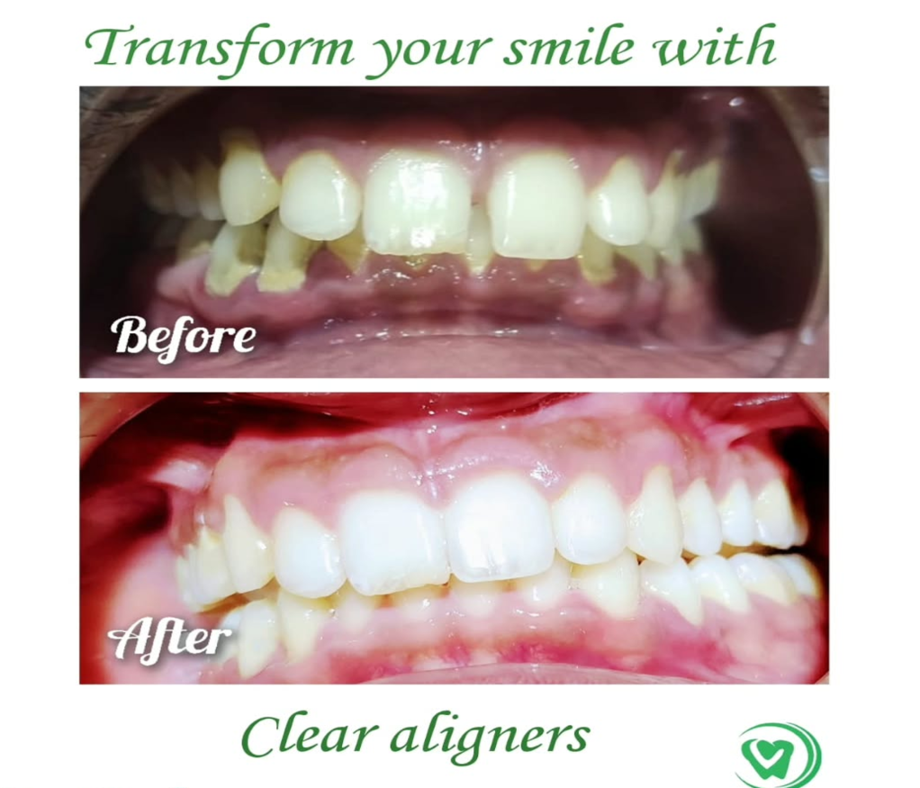 Clear Aligner Usage Before & After Picture of a Patient at Vallamattam Dental Clinic Kakkanad