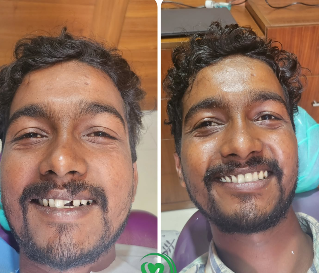 Smilemakeover Before & After Picture of a Patient at Vallamattam Dental Clinic Kakkanad