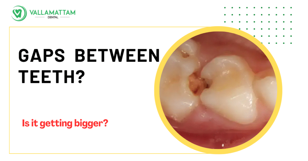 Teeth Gap topic Blog image of a patient's teeth with gap