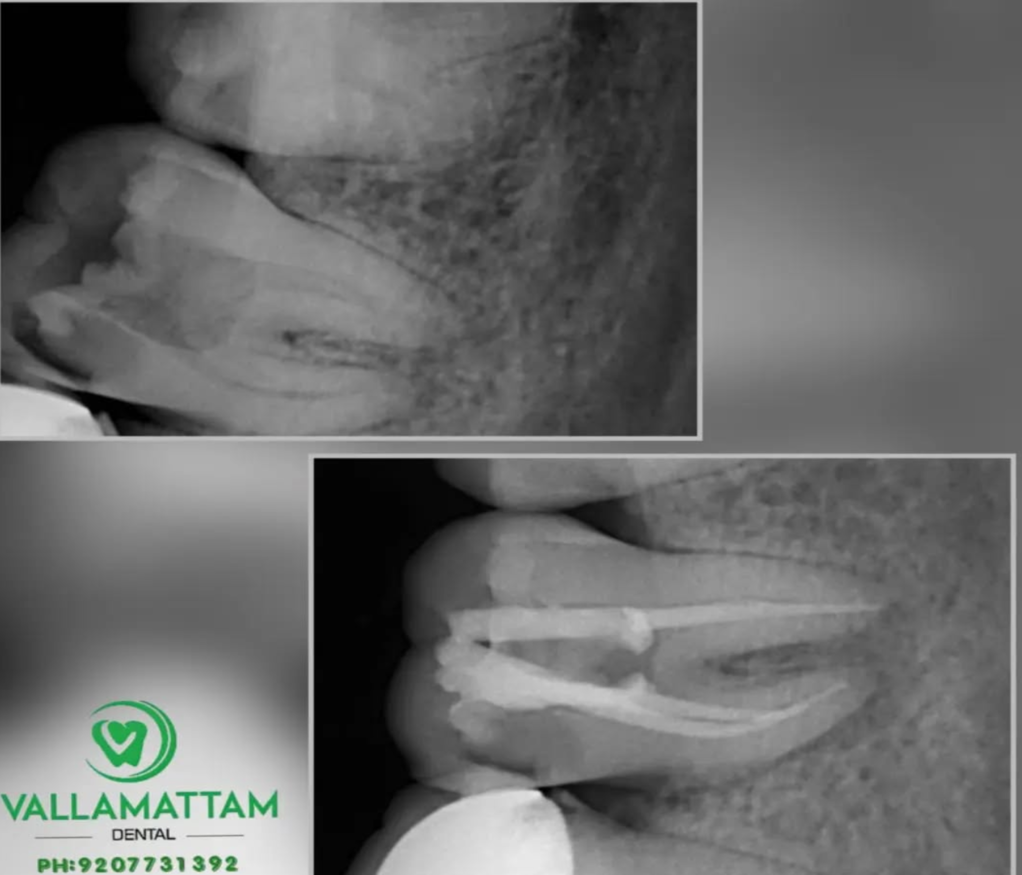 X ray of a tooth that Require Root canal Treatment at vallamattam Dental Clinic Kakkanad