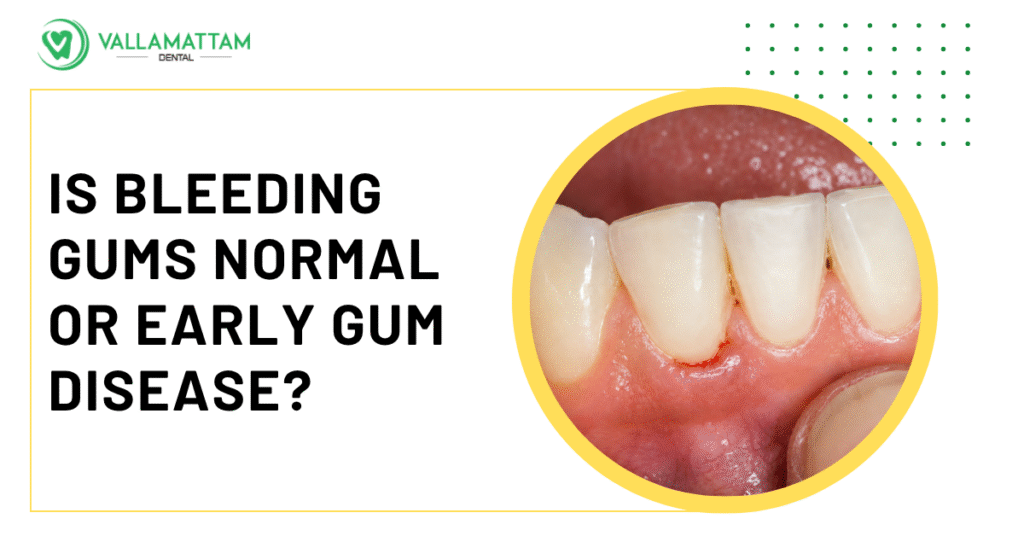 Bleeding After Flossing: Is It Normal Or A Sign Of Gum Disease?